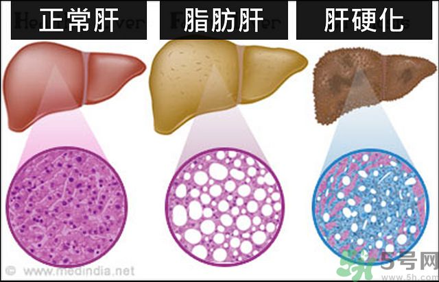得了脂肪肝該怎么治？脂肪肝對人體危害有多大？