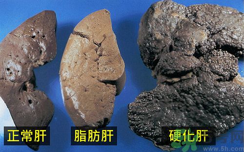 得了脂肪肝該怎么治？脂肪肝對人體危害有多大？