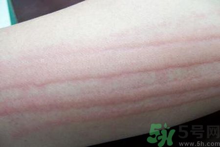 蕁麻疹會不會傳染？蕁麻疹怎么治才能好？