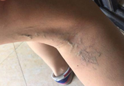 40歲女性小腿靜脈曲張怎么辦？