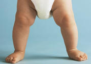 孩子一個腿長一個腿短是什么??？孩子長短腿怎么辦？