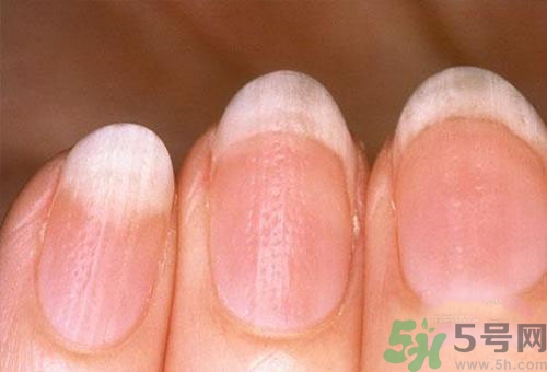 指甲發(fā)白是怎么回事？指甲發(fā)白代表什么？