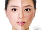 激光美白有用嗎？激光美白可以維持多久？