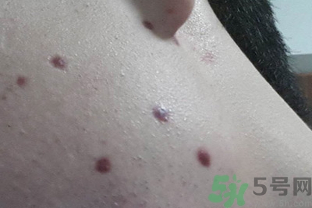 激光點(diǎn)痣后可以洗臉嗎？激光點(diǎn)痣后需要注意什么？