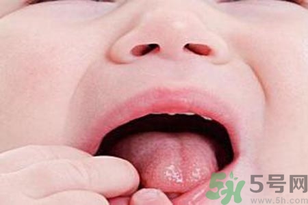 寶寶口腔潰瘍?cè)趺崔k？治療寶寶口腔潰瘍方法有什么？