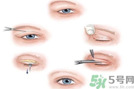 割雙眼皮分哪幾種？割雙眼皮需要多少錢？
