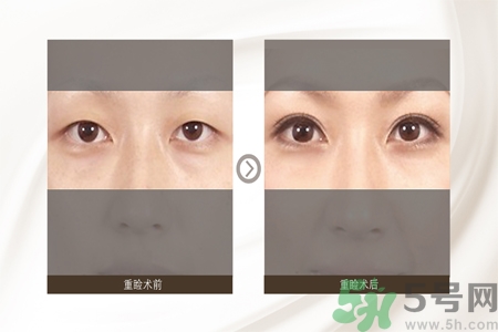 割雙眼皮分哪幾種？割雙眼皮需要多少錢(qián)？