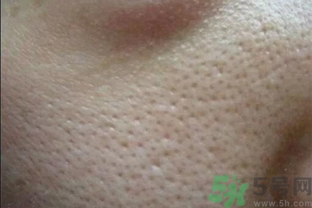 皮膚毛孔粗大原因有哪些？如何預(yù)防皮膚毛孔粗大？