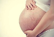 什么是妊娠紋？妊娠紋什么時(shí)候開始長(zhǎng)？