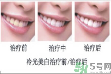 冷光美白牙齒是什么？冷光美白牙齒的好處有哪些？