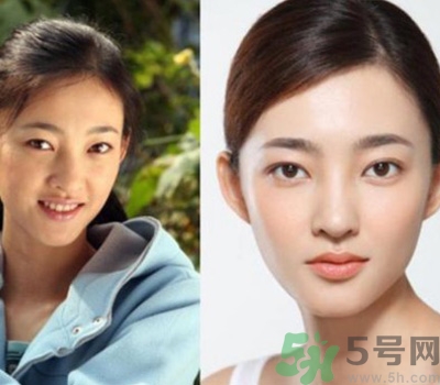 開眼角眼睛會(huì)變大嗎？開眼角眼睛能大多少？