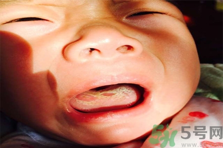 舌頭燙傷后該怎么辦呢？舌頭燙傷后應(yīng)該注意吃什么？?