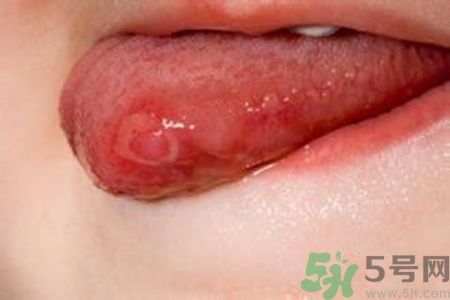 舌頭長泡怎么辦？舌頭長泡的原因？