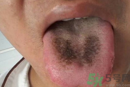 舌頭發(fā)黑怎么回事？舌頭發(fā)黑怎么辦？