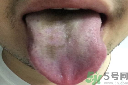 舌頭發(fā)黑怎么回事？舌頭發(fā)黑怎么辦？