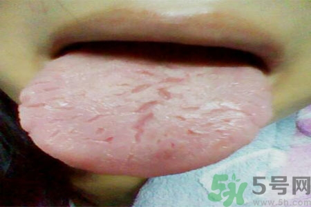 舌頭上有裂紋是怎么辦？舌頭上有裂紋是什么原因？