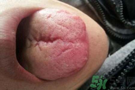 舌頭上有裂紋是怎么辦？舌頭上有裂紋是什么原因？