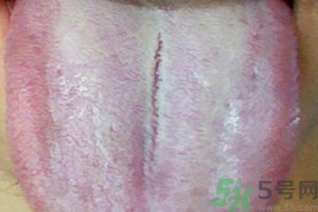 舌頭發(fā)白是什么原因？舌苔發(fā)白是怎么辦？