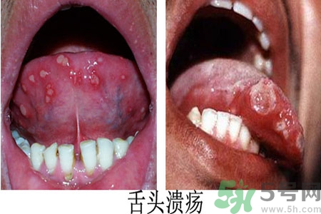 舌頭潰瘍?cè)趺崔k？舌頭潰瘍的原因？