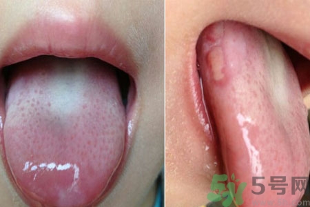 舌頭潰瘍?cè)趺崔k？舌頭潰瘍的原因？