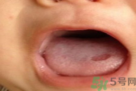 舌頭潰瘍?cè)趺崔k？舌頭潰瘍的原因？