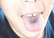 舌頭發(fā)黑怎么回事？舌頭發(fā)黑怎么辦？