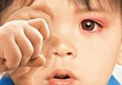 寶寶得了紅眼病怎么辦？寶寶得了紅眼病怎么治？