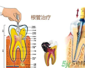 什么是根管治療？為什么牙齒疼要做根管治療？
