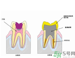 什么是根管治療？為什么牙齒疼要做根管治療？