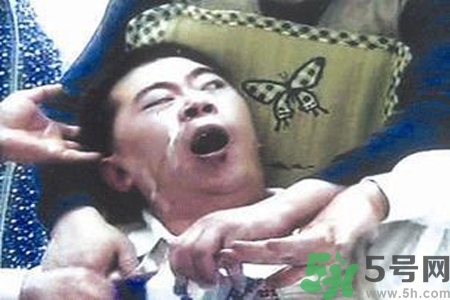 癲癇的典型癥狀有哪些？癲癇是什么？