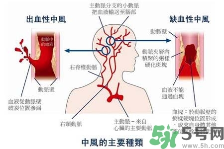 腦中風(fēng)是什么？腦中風(fēng)的癥狀？