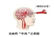 腦中風(fēng)的發(fā)病因素？腦中風(fēng)的并發(fā)癥有哪些 ？