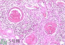 慢性腎炎能治好嗎？慢性腎炎能活多久？