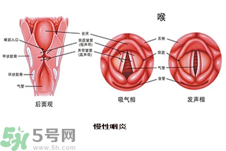 慢性咽炎是什么？慢性咽炎的癥狀有哪些？