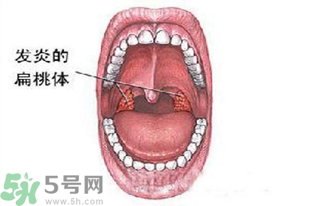 慢性咽炎是什么？慢性咽炎的癥狀有哪些？