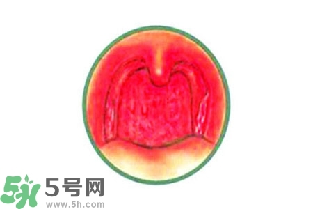 慢性咽炎的治療方法？慢性咽炎的藥物治療？