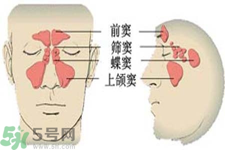 鼻竇炎是什么？鼻竇炎的癥狀有哪些？