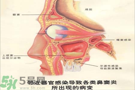 鼻竇炎是什么？鼻竇炎的癥狀有哪些？