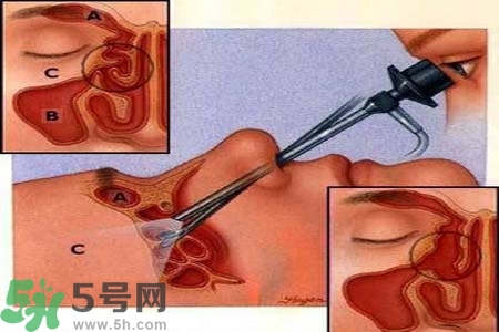 鼻竇炎的高發(fā)人群？如何預(yù)防鼻竇炎？