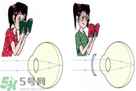 近視眼的發(fā)病因素？近視眼的并發(fā)癥有哪些？