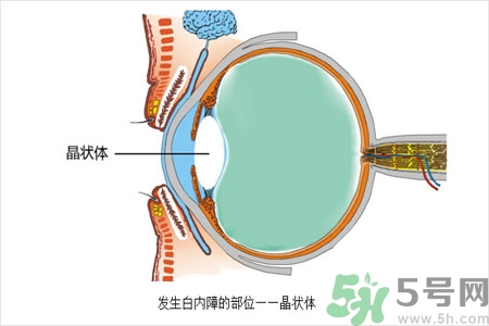 白內(nèi)障的護(hù)理措施是什么？白內(nèi)障的飲食護(hù)理有哪些？