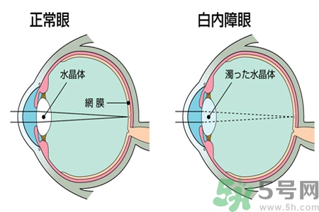 白內(nèi)障的發(fā)病因素是什么?白內(nèi)障并發(fā)癥有哪些? 白內(nèi)障的發(fā)病因素是什么?白內(nèi)障并發(fā)癥有哪些?