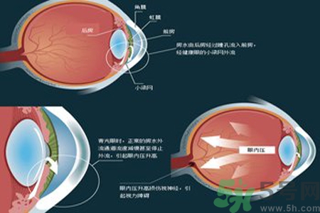 青光眼是什么？青光眼癥狀有什么？