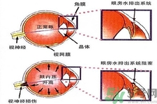青光眼的發(fā)病因素是什么？青光眼的并發(fā)癥有哪些？