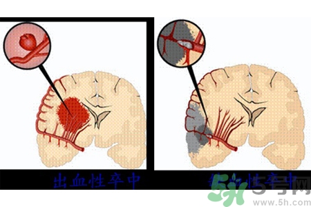 腦出血的發(fā)病因素是什么？腦出血的并發(fā)癥有哪些？