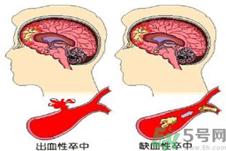 腦出血的治療方法是什么？腦出血可以用哪些藥物治療？