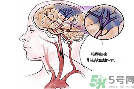 腦出血的治療方法是什么？腦出血可以用哪些藥物治療？