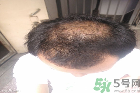 脫發(fā)的措施有什么？脫發(fā)的注意飲食有哪些？