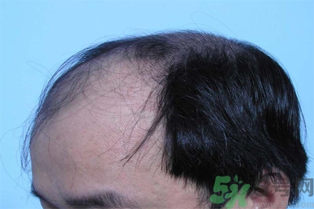 脫發(fā)的措施有什么？脫發(fā)的注意飲食有哪些？