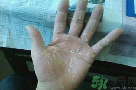 引起手足癬的主要原因？手足癬會(huì)引發(fā)什么疾??？